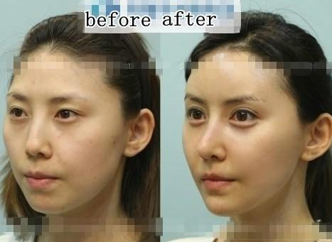 韩国惊人整容新案例 歪脸妹变美女