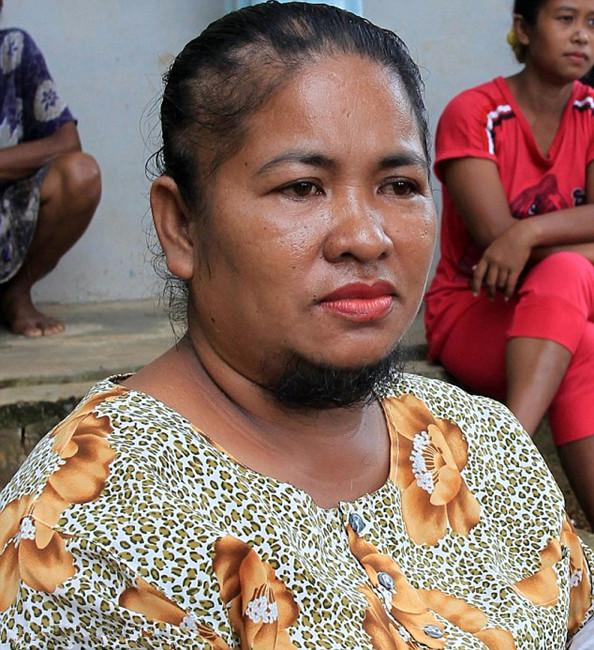 女子长山羊胡19年不敢“露脸”